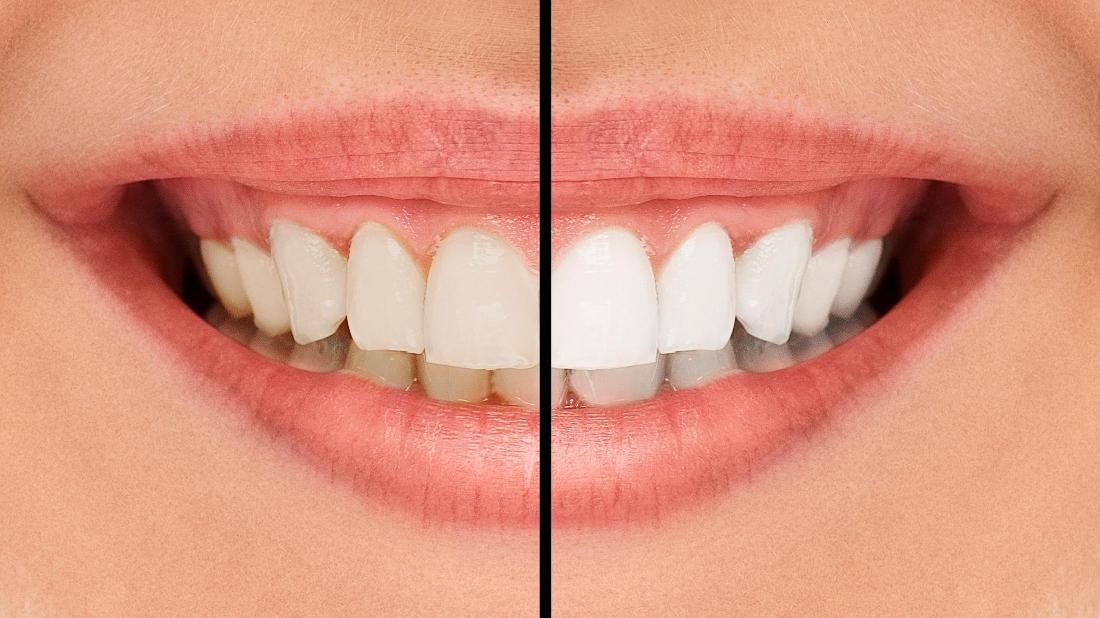 Your Teeth Can Be Shades Whiter with a TakeHome Teeth Whitening System Teeth Whitening Prosper TX