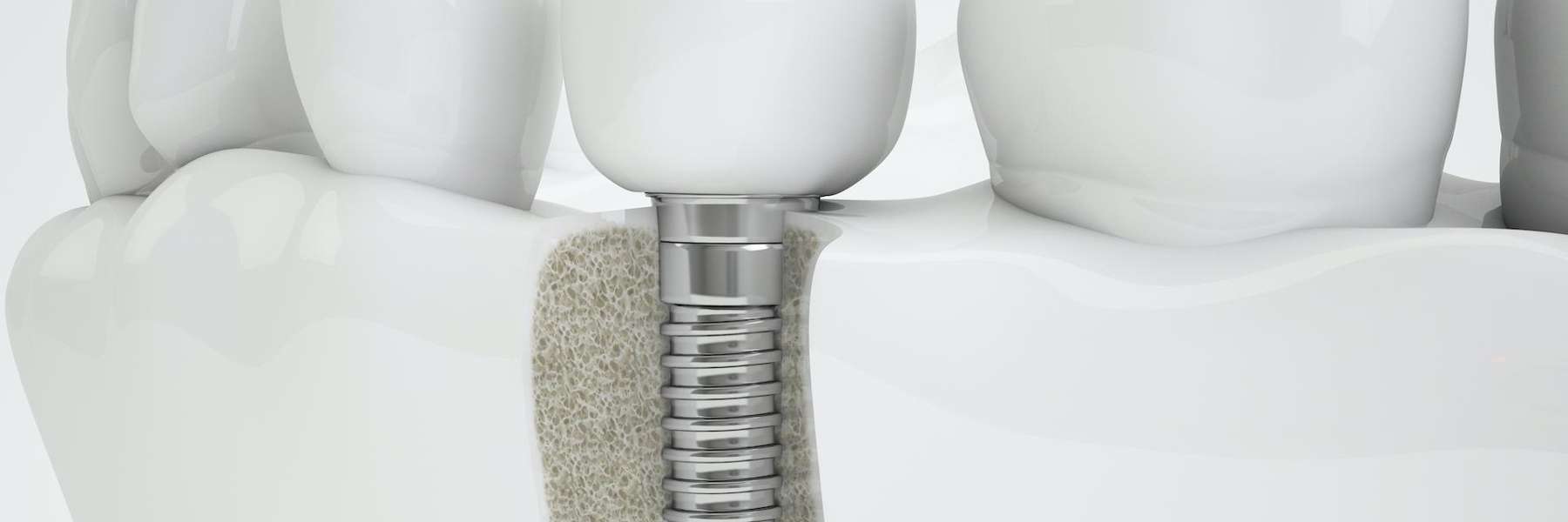 Dental implant in Prosper TX