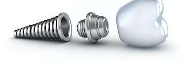 Dental implant parts in Prosper TX