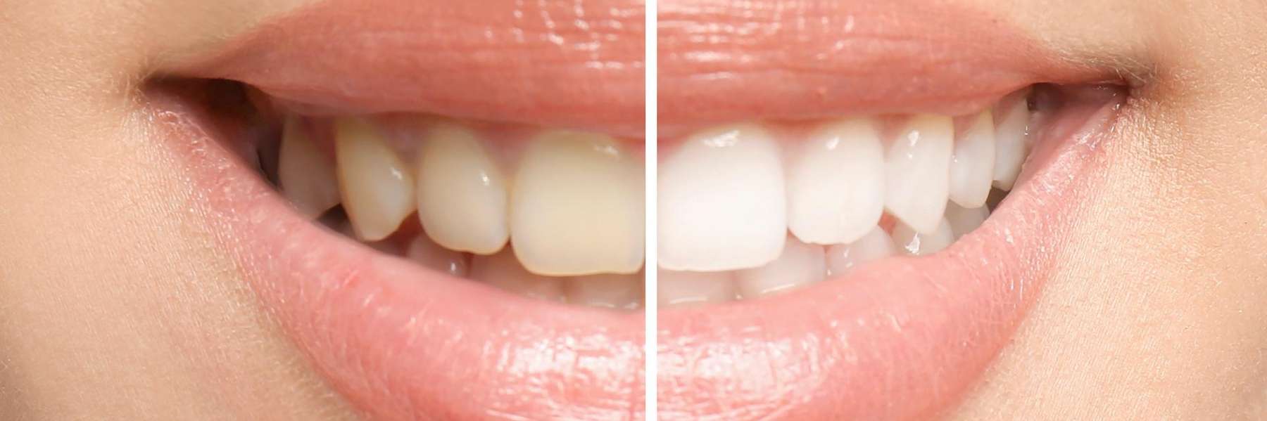Before and after of a woman's teeth showing whitening results.
